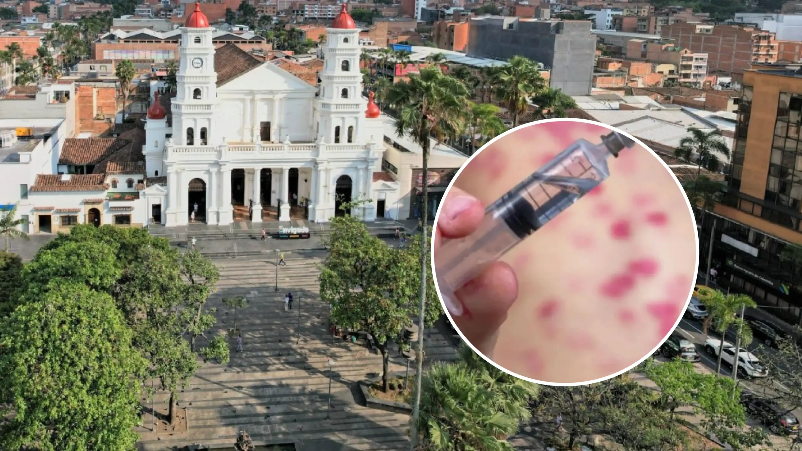 Atención: en Envigado fue detectado el primer caso de la variante IB de la viruela del mono ¿Qué riesgo hay?